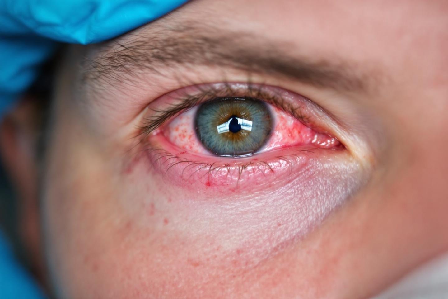 Quelles sont les contre-indications pour le yoga des yeux ?